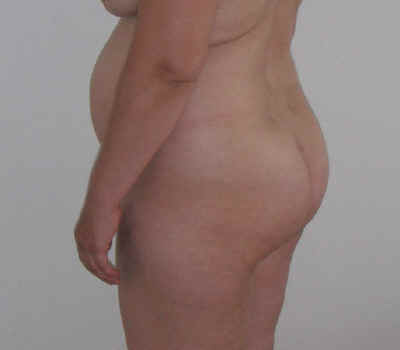 Victim of no-salt yoyo diets